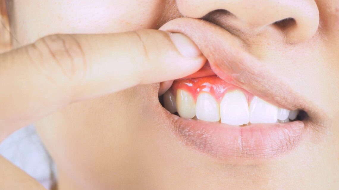 Gum Disease In Ealing