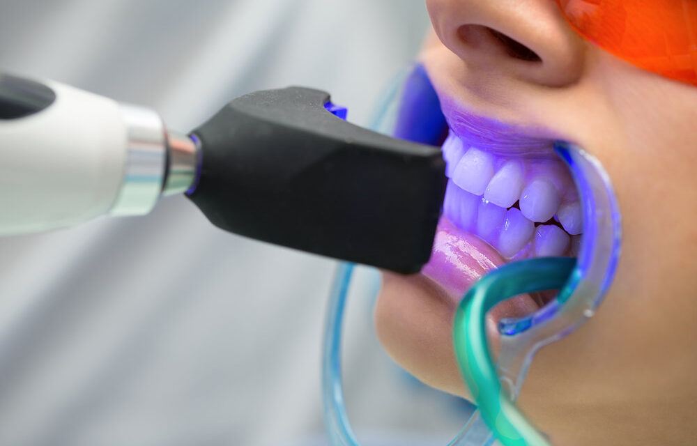 Teeth Whitening in ealing -dentist in ealing