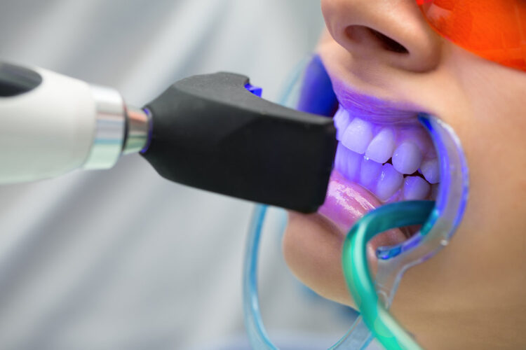 Teeth Whitening in ealing -dentist in ealing
