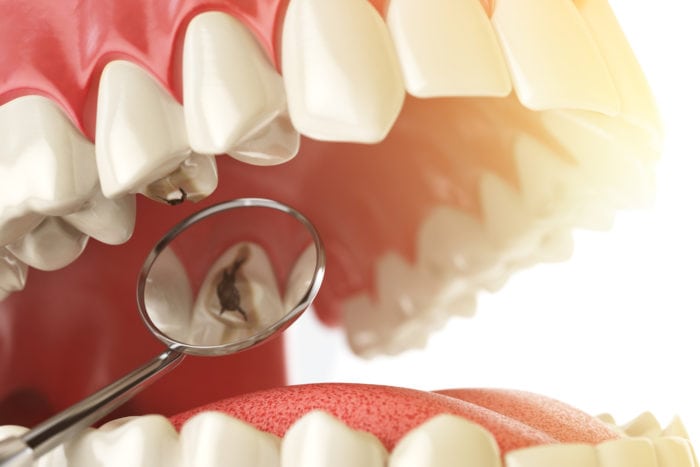 Tooth Decay And Cavities In Ealing